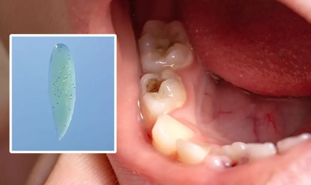 Zahnarzt: „Wie gesunder Zahnschmelz“ – Forscher entwickeln Gel zum Schutz der Zähne vor Löchern und Karies