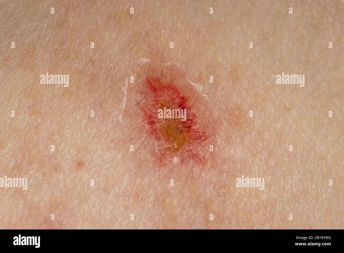 Gürtelrose: Wer wirklich gefährdet ist und warum Impfung mehr kann als nur schützen - image 1